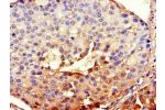 Immunohistochemistry of paraffin-embedded human breast cancer using CSB-PA002691LA01HU at dilution of 1:100