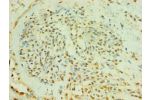 Immunohistochemistry of paraffin-embedded human breast cancer using CSB-PA002714ESR1HU at dilution 1:100