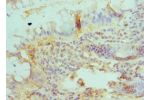 Immunohistochemistry of paraffin-embedded human colon cancer using CSB-PA002716ESR2HU at dilution 1:100