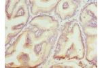 Immunohistochemistry of paraffin-embedded human prostata cancer using CSB-PA002721ESR1HU at dilution 1:100