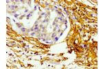 Immunohistochemistry of paraffin-embedded human breast cancer using CSB-PA002734LA01HU at dilution of 1:100