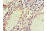 Immunohistochemistry of paraffin-embedded human colon cancer using CSB-PA002767ESR2HU at dilution 1:100