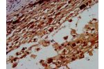 IHC image of CSB-PA002854LA01HU diluted at 1:400 and staining in paraffin-embedded human melanoma cancer performed on a Leica BondTM system. After dewaxing and hydration, antigen retrieval was mediated by high pressure in a citrate buffer (pH 6.0). Sectio