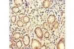 Immunohistochemistry of paraffin-embedded human gastric cancer using CSB-PA002882LA01HU at dilution of 1:100