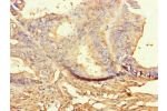 Immunohistochemistry of paraffin-embedded human endometrial cancer using CSB-PA002883LA01HU at dilution of 1:100