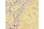 Immunohistochemistry of paraffin-embedded human lung cancer using CSB-PA003497LA01HU at dilution of 1:100