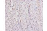 Immunohistochemistry of paraffin-embeded human colorectal carcinoma using CSB-PA003648LA01HU at dilution of 1:20