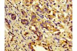 Immunohistochemistry of paraffin-embedded human liver cancer using CSB-PA003657LA01HU at dilution of 1:100
