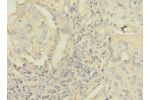 Immunohistochemistry of paraffin-embedded human lung cancer CSB-PA003951LA01HU at dilution 1:100