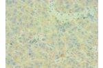 Immunohistochemistry of paraffin-embedded human liver cancer using CSB-PA003954ESR2HU at dilution 1:100