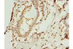 Immunohistochemistry of paraffin-embedded human breast cancer using CSB-PA004170LA01HU at dilution of 1:100