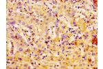IHC image of CSB-PA004372LA01HU diluted at 1:100 and staining in paraffin-embedded human liver cancer performed on a Leica BondTM system. After dewaxing and hydration, antigen retrieval was mediated by high pressure in a citrate buffer (pH 6.0). Section w