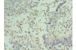 Immunohistochemistry of paraffin-embedded human cervical cancer using CSB-PA004812ESR2HU at dilution 1:100
