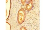 Immunohistochemistry of paraffin-embedded human prostate cancer using CSB-PA004831LA01HU at dilution of 1:100