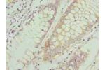 Immunohistochemistry of paraffin-embedded human colon cancer using CSB-PA004839LA01HU at dilution of 1:100
