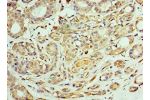 Immunohistochemistry of paraffin-embedded human breast cancer using CSB-PA004865ESR1HU at dilution 1:100