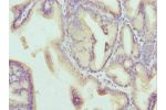 Immunohistochemistry of paraffin-embedded human prostate cancer using CSB-PA004890ESR2HU at dilution 1:100
