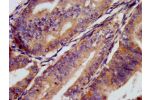 IHC image of CSB-PA004893LA01HU diluted at 1:300 and staining in paraffin-embedded human endometrial cancer performed on a Leica BondTM system. After dewaxing and hydration, antigen retrieval was mediated by high pressure in a citrate buffer (pH 6.0). Sec