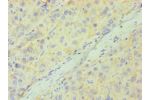 Immunohistochemistry of paraffin-embedded human liver cancer using CSB-PA004925ESR2HU at dilution 1:100