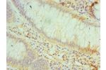 Immunohistochemistry of paraffin-embedded human colon cancer using CSB-PA004941ESR1HU at dilution 1:100