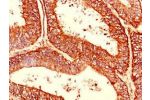 Immunohistochemistry of paraffin-embedded human endometrial cancer using CSB-PA005004LA01HU at dilution of 1:100