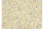 Immunohistochemistry of paraffin-embedded human gastric cancer CSB-PA005013LA01HU at dilution 1:100