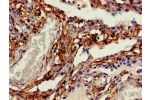 Immunohistochemistry of paraffin-embedded human lung cancer using CSB-PA005036EA01HU at dilution of 1:100