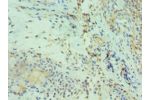 Immunohistochemistry of paraffin-embedded human breast cancer using CSB-PA005039ESR1HU at dilution 1:100