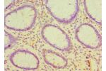 Immunohistochemistry of paraffin-embedded human colon cancer using CSB-PA005041ESR2HU at dilution 1:100