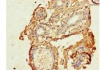 Immunohistochemistry of paraffin-embedded human breast cancer using CSB-PA005075LA01HU at dilution of 1:100
