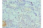 Immunohistochemistry of paraffin-embedded human breast cancer using CSB-PA005077DSR2HU at dilution 1:100