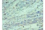 Immunohistochemistry of paraffin-embedded human endometrial cancer using CSB-PA005079ESR1HU at dilution 1:100