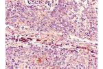 Immunohistochemistry of paraffin-embedded human cervical cancer using CSB-PA005089LA01HU at dilution of 1:100