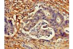 Immunohistochemistry of paraffin-embedded human colon cancer using CSB-PA005094LA01HU at dilution of 1:100