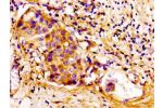 Immunohistochemistry of paraffin-embedded human breast cancer using CSB-PA005096LA01HU at dilution of 1:100