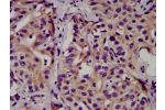 IHC image of CSB-PA005158LA01HU diluted at 1:500 and staining in paraffin-embedded human liver cancer performed on a Leica BondTM system. After dewaxing and hydration, antigen retrieval was mediated by high pressure in a citrate buffer (pH 6.0). Section w