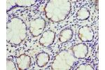 Immunohistochemistry of paraffin-embedded human colon cancer using CSB-PA005163ESR2HU at dilution 1:100
