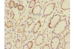 Immunohistochemistry of paraffin-embedded human colon cancer using CSB-PA005164ESR1HU at dilution 1:100
