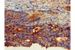 Immunohistochemistry of paraffin-embedded human colon cancer using CSB-PA005166LA01HU at dilution of 1:100