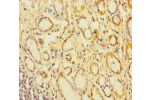 Immunohistochemistry of paraffin-embedded human gastric cancer using CSB-PA005167LA01HU at dilution of 1:100