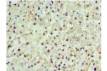 Immunohistochemistry of paraffin-embedded human liver cancer using CSB-PA005220ESR2HU at dilution 1:100