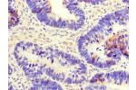 Immunohistochemistry of paraffin-embedded human ovarian cancer using CSB-PA005241LA01HU at dilution of 1:100