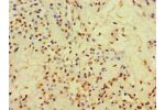 Immunohistochemistry of paraffin-embedded human breast cancer using CSB-PA005271ESR2HU at dilution 1:100