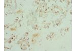 Immunohistochemistry of paraffin-embedded human bladder cancer using CSB-PA005272DSR1HU at dilution 1:100