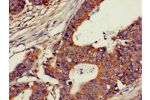 Immunohistochemistry of paraffin-embedded human colon cancer using CSB-PA005307LA01HU at dilution of 1:100