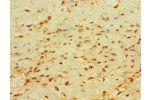 Immunohistochemistry of paraffin-embedded human breast cancer using CSB-PA005325ESR2HU at dilution 1:100