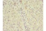Immunohistochemistry of paraffin-embedded human liver cancer tissue using CSB-PA005472LA01HU at dilution 1:100