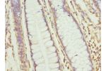 Immunohistochemistry of paraffin-embedded human colon cancer using CSB-PA005486ESR1HU at dilution 1:100