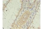 Immunohistochemistry of paraffin-embedded human colon cancer using CSB-PA005495EA01HU at dilution 1:100