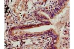 Immunohistochemistry of paraffin-embedded human lung cancer using CSB-PA005507LA01HU at dilution of 1:100